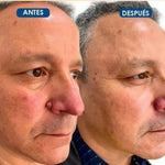 FormuClear™ - Elimina verrugas sin dolor y seguro + ENVIO GRATIS