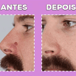 🔥  LAPIZ CAUTERIZADOR DE VERRUGAS SIN DOLOR + ENVIO GRATIS!