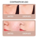 🔥  LAPIZ CAUTERIZADOR DE VERRUGAS SIN DOLOR + ENVIO GRATIS!